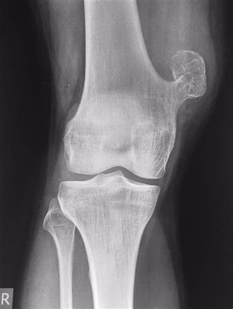 Osteochondroma; Chondrosteoma; Exostosis, Osteocartilaginous; Exostosis, Cartilaginous