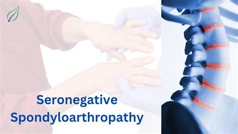 Seronegative Spondyloarthropathy: Symptoms, Causes, and Treatment | Best Back Pain, Slip Disc ...