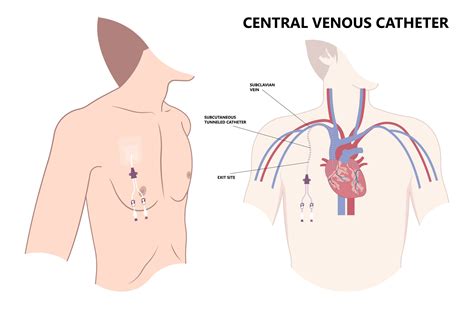 Hickman Line (Hickman catheter) | VIRQ