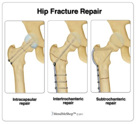 Superdrug Health Clinic: Hip Fracture Recovery