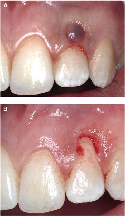 Peripheral Giant Cell Granuloma Vs Pyogenic Granuloma