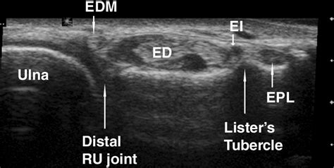 Normal Sonographic Anatomy of the Wrist and Hand | RadioGraphics