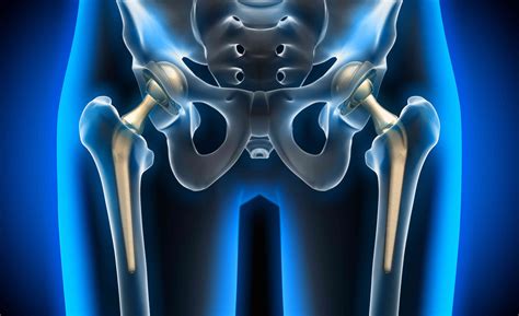 Total Hip Arthroplasty: Procedure Benefits And Risks – Brandon Orthopedics