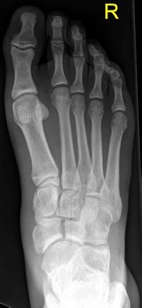 Avulsion Fracture Navicular Bone Foot