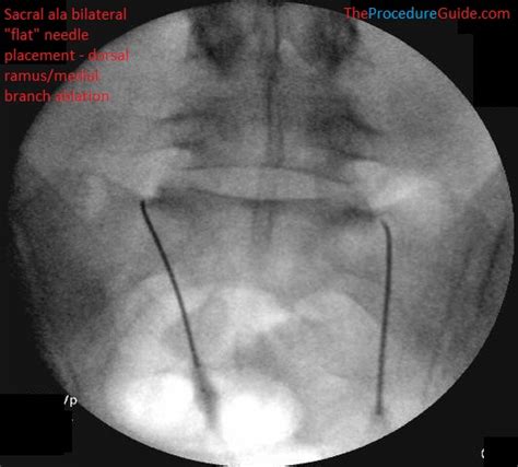 Sacroiliac Joint Nerve Block