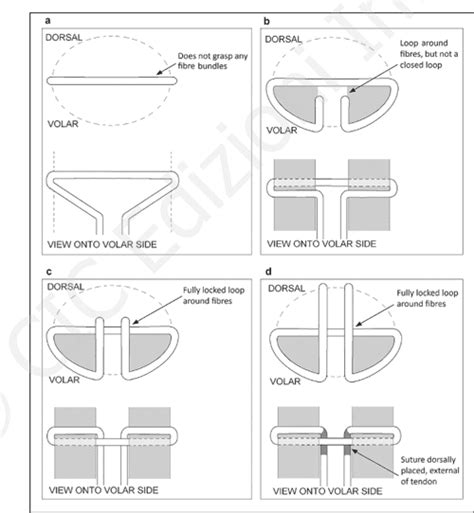 [PDF] Suture techniques for tendon repair; a comparative review. | Semantic Scholar