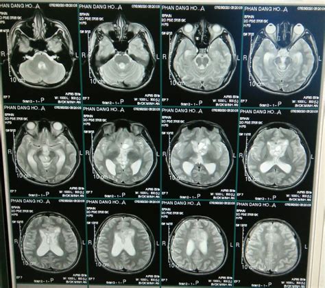 Phát hiện một trường hợp u não hiếm gặp nhờ chụp MRI tại BVĐK Minh An U ...