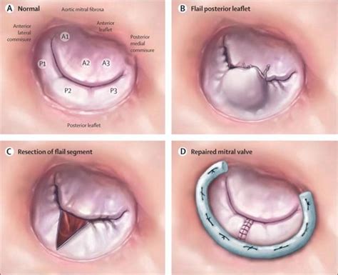 Pin by nonas arc on Cleft Mitral Valve | Cardiac sonography, Medical ...