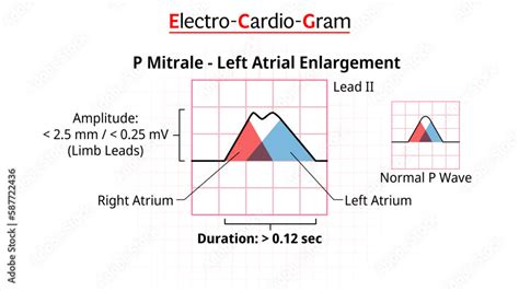 P Wave - P Mitrale - ECG Left Atrial Enlargement/Hypertrophy ...