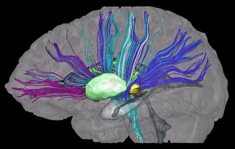 DTI: Fiber Tracking | Brain images, Kirby, Development