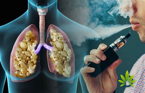Does vaping lead to popcorn lung disease? Here is what you need to know ...
