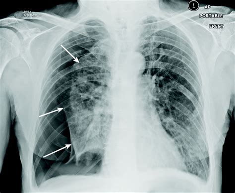 Spontaneous pneumothorax | The BMJ