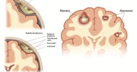 Best Doctors & Hospitals in India for Brain Abscess Treatment