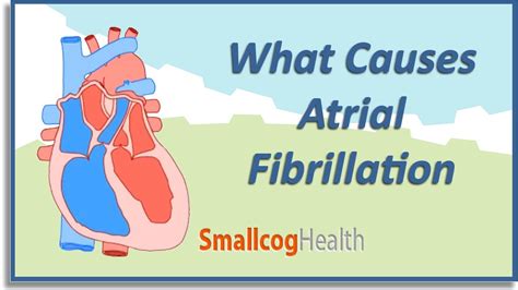 What Causes Atrial Fibrillation - YouTube smallcogbigmachine - regions ...