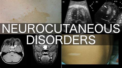 Neurocutaneous Disorders - YouTube