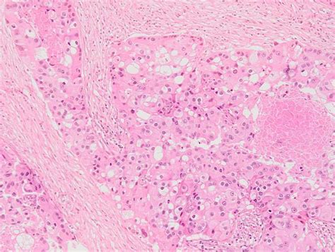 Apocrine carcinoma of the breast – BosnianPathology