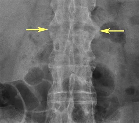 RiT radiology: Seronegative Spondyloarthropathy (SNSA)