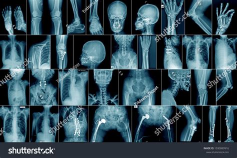 4,268 Tibia x ray Stock Photos, Images & Photography | Shutterstock