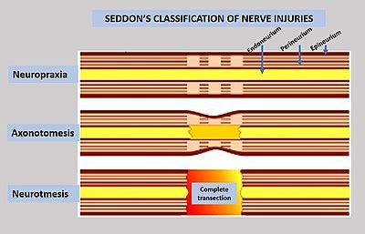 Nerve injury Flashcards | Quizlet