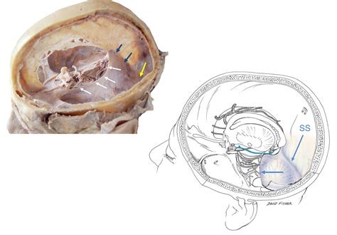 Cureus | The Tentorium Cerebelli: A Comprehensive Review Including Its Anatomy, Embryology, and ...