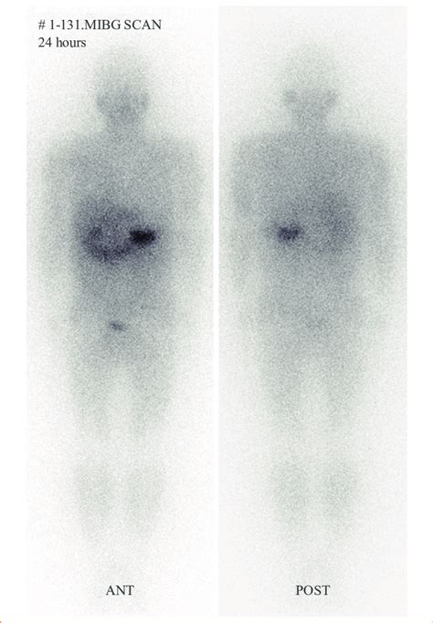 131 I-Metaiodobenzylguanidine (MIBG) scan shows an increased uptake in... | Download Scientific ...