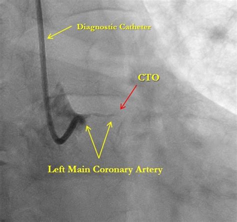 Percutaneous Intervention of Left Main Coronary Artery Chronic Total Occlusion - Open Access Pub