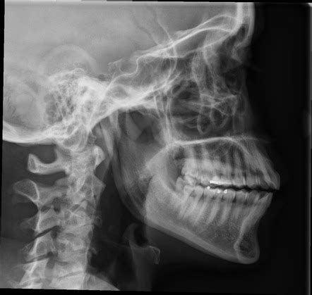 Normal mandible series | Image | Radiopaedia.org