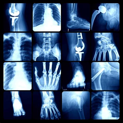 Causes, Symptoms, and Treatment of Osteopetrosis