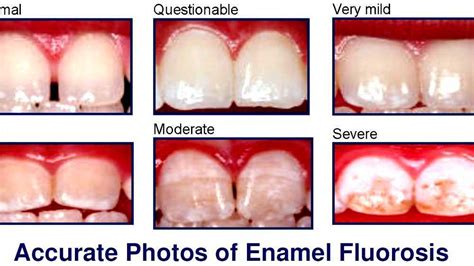 Dental fluorosis