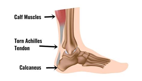 Achilles Tendon Rupture - Symptoms, Causes & Treatment