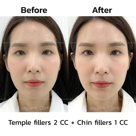 Chin filler to solve short chin problems, chin reduction, adjust the face to appear more slender.