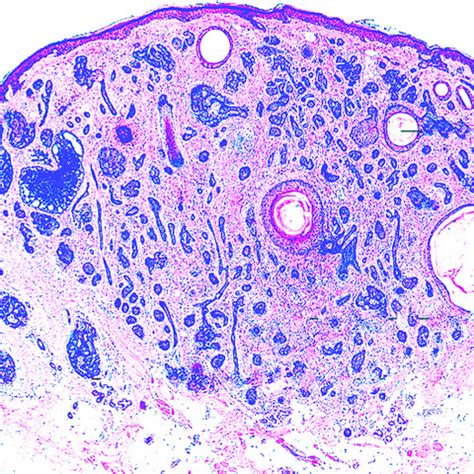 Pathology Outlines - Trichoepithelioma / trichoblastoma