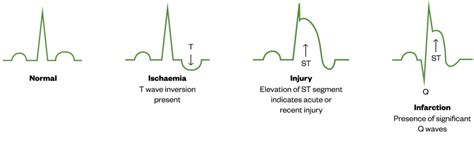 Diagnosis and management of stable angina - The Pharmaceutical Journal