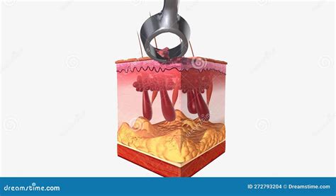 The Curettage and Electrodesiccation Close Up Stock Illustration - Illustration of medical ...