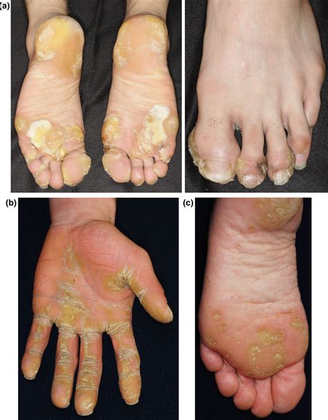 Figure 7 from Hereditary palmoplantar keratoderma "clinical and genetic ...