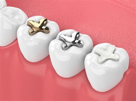 Northside Dental Clinic Pros and Cons of Ceramic Fillings