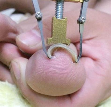 Toenails Growing At An Angle? Possible Causes And Treatments