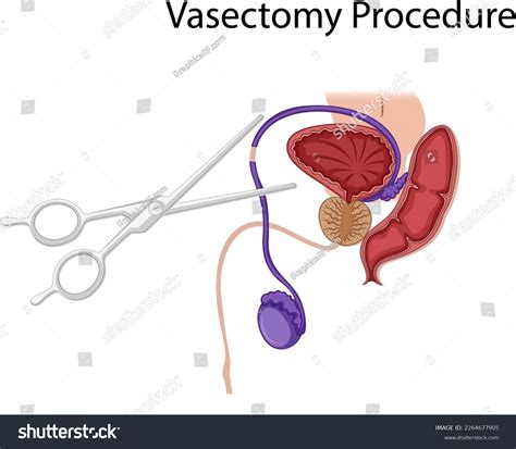 Diagram Showing Vasectomy Procedure Illustration Stock Vector (Royalty ...