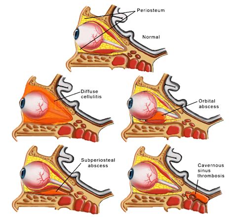 Morris Hartstein, MD | Cosmetic Reconstructive Surgery eyelids orbits