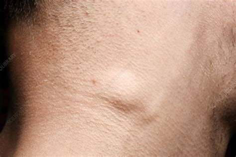 Swollen lymph node in infection - Stock Image - C029/4959 - Science ...