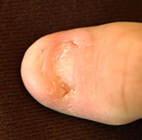 Nail Patella syndrome | Skin & Hair problems articles | Body & Health Conditions center ...