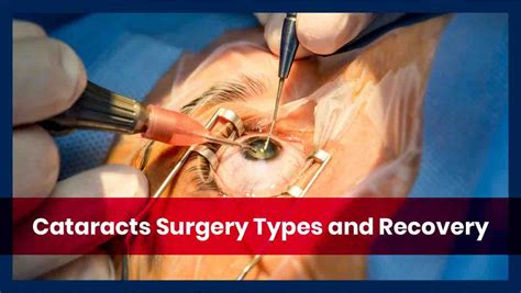 Cataracts Surgery - What you Should Know - USHEALTH Group