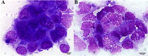 Conventional cytology results: positive IFCCs (A) and cytolysis after ...