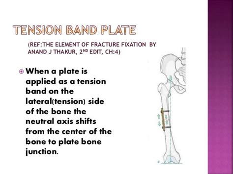 Principle of tension band wiring n its application