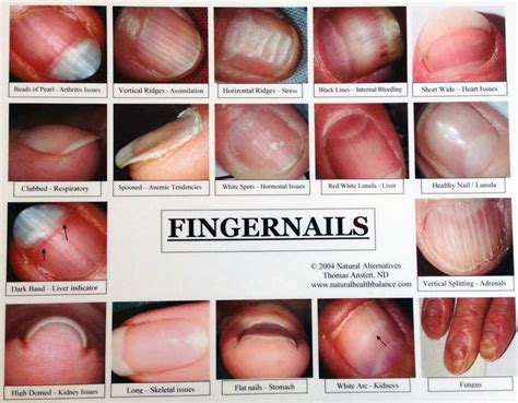 How To Tell If Your Fingers Are Clubbing - Margaret Greene Kapsels