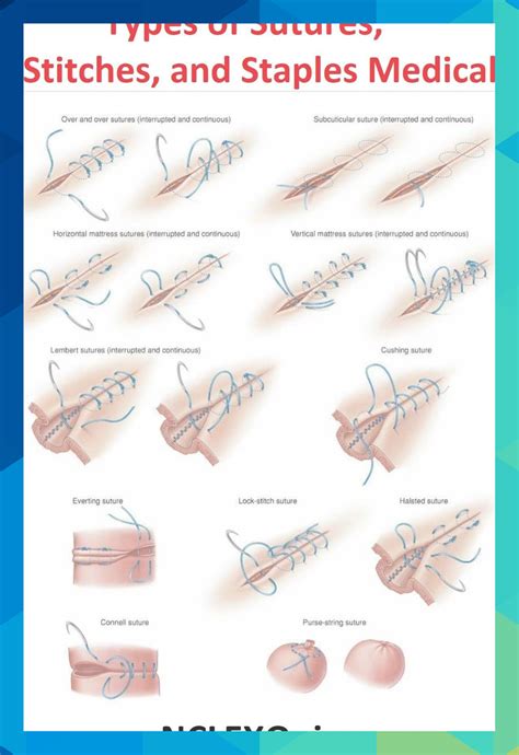 Types of Sutures, Stitches, and Staples Medical Wound Care Suturing Techniques Removing Stitches ...