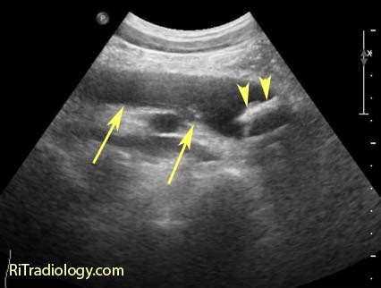 RiT radiology: Pyonephrosis