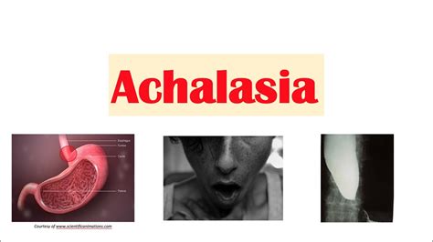 Achalasia | Pathophysiology, Causes, Signs & Symptoms, Diagnosis, Treatment - YouTube