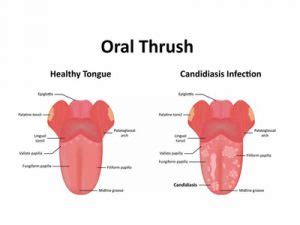 Oral Thrush: Symptoms, Causes, and Treatments - My Dentist Burbank