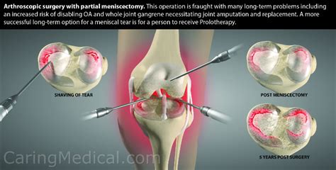 Arthroscopic knee surgery in a middle-age patient. Are there non-surgical options?